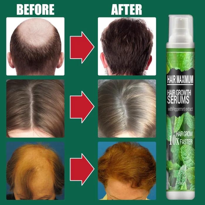 Spray Hair Maximum™ - Crescimento Capilar 10x mais Rápido